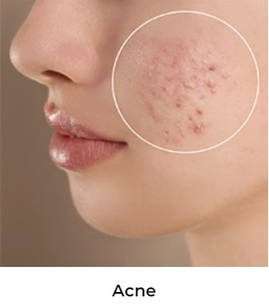 Lady with acne on cheeks
