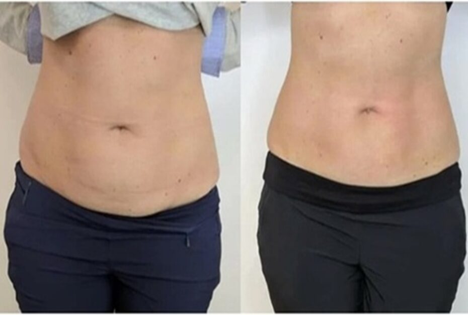 cryo ab slimming before and after